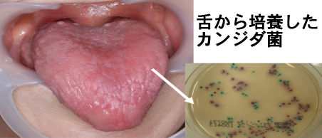 舌から培養したカンジダ菌