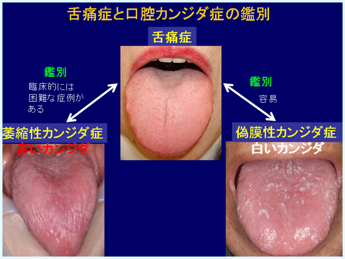 舌痛症と口腔カンジダ症の鑑別