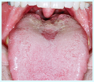 正中菱型舌炎