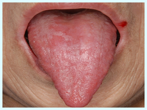 委縮性カンジダ症(紅斑性カンジダ症) - 口角炎 併発症例
