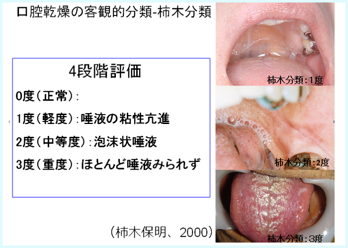 口腔乾燥の客観的分類 - 柿木分類