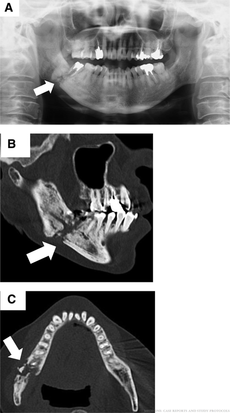放射線性下顎骨壊死に薬剤関連顎骨壊死の合併が疑われた症例