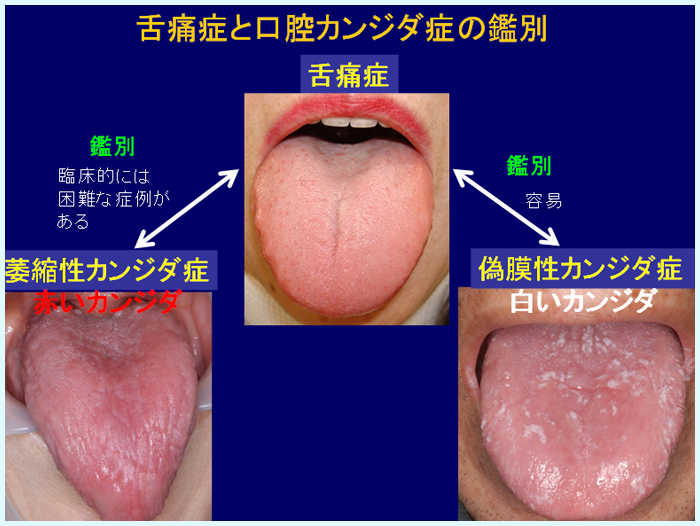 舌痛症 - 北海道大学歯学部 口腔診断内科
