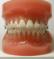  Development of clear orthodontic wire using composite materials