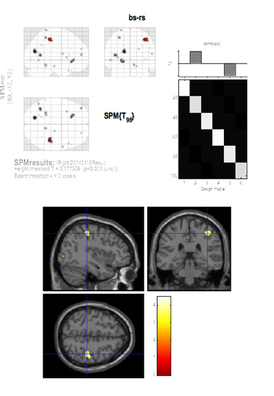 fMRI analysis of reduced brain function area when chewing shifts to the right during a smile