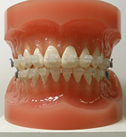 Development of clear orthodontic wire using composite materials